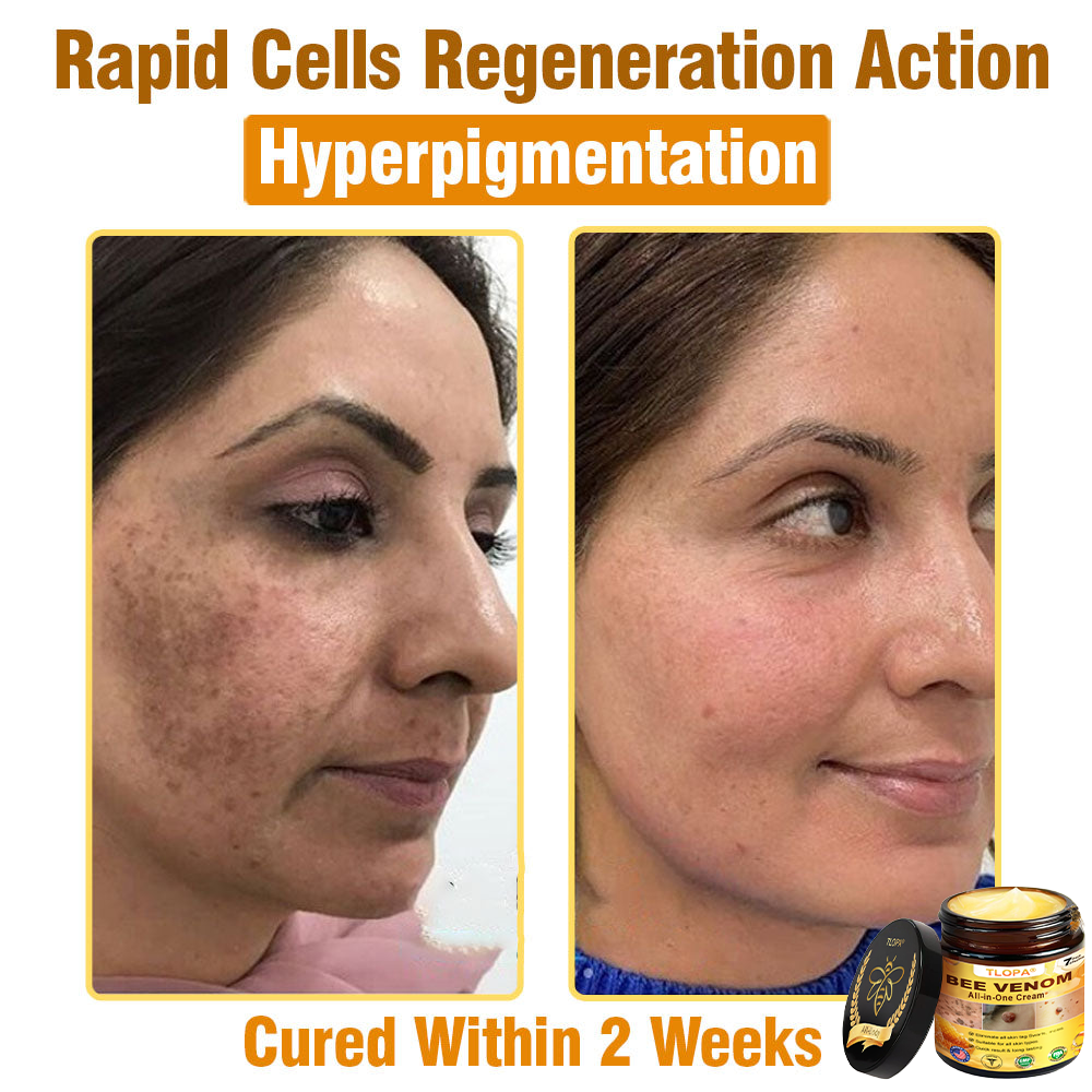 TLOPA® Bee Venom All-in-One Cream US Dermatologist Approved-