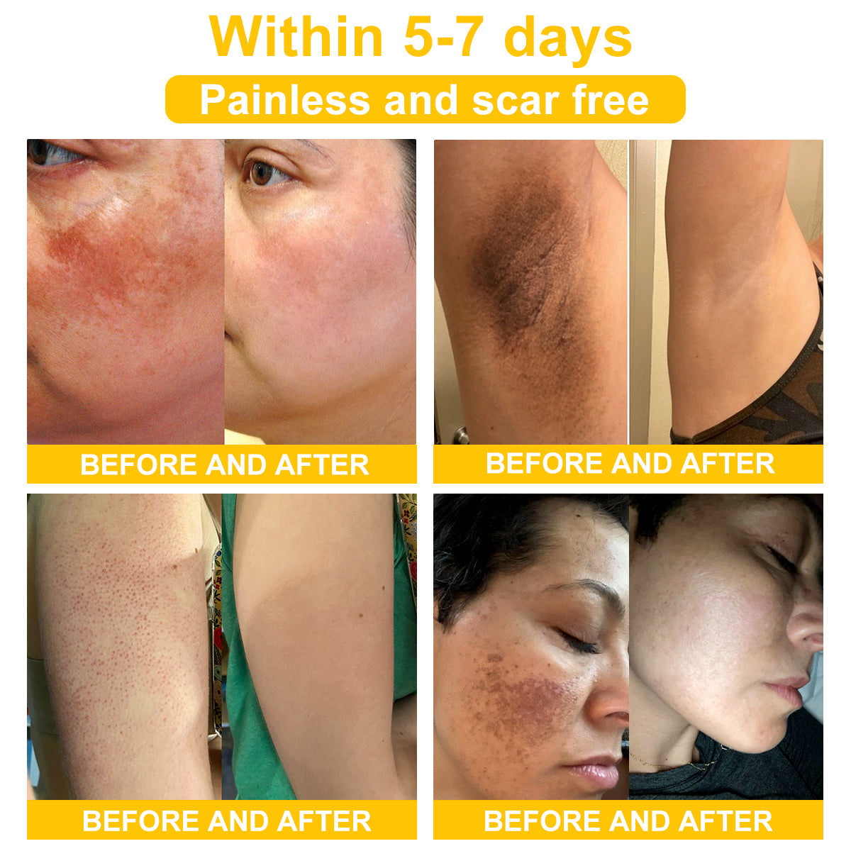 TLOPA® Bee Venom Skin Cream(👨⚕AAD Recommended),for Remove Warts, Acne and Scars ✅