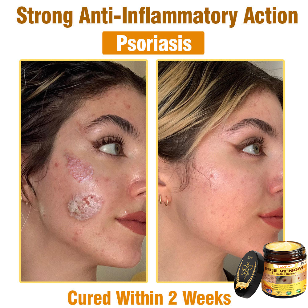 TLOPA® Bee Venom All-in-One Cream US Dermatologist Approved-
