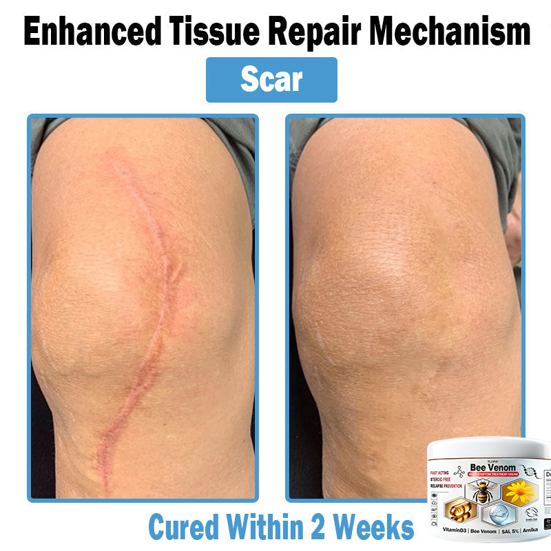 TLOPA® Bee Venom Multi-Symptom Skin Treatment Cream (👨⚕🌟Extra 30% off on sale items!