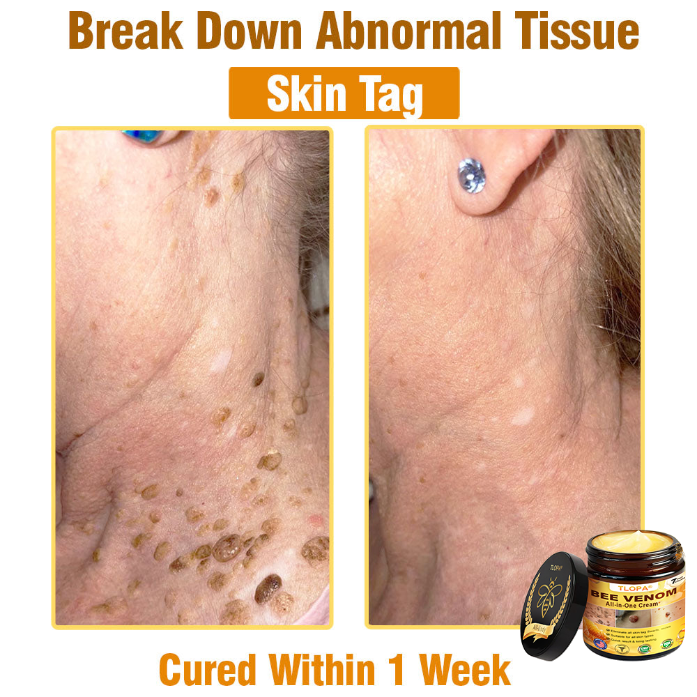 TLOPA® Bee Venom All-in-One Cream US Dermatologist Approved-
