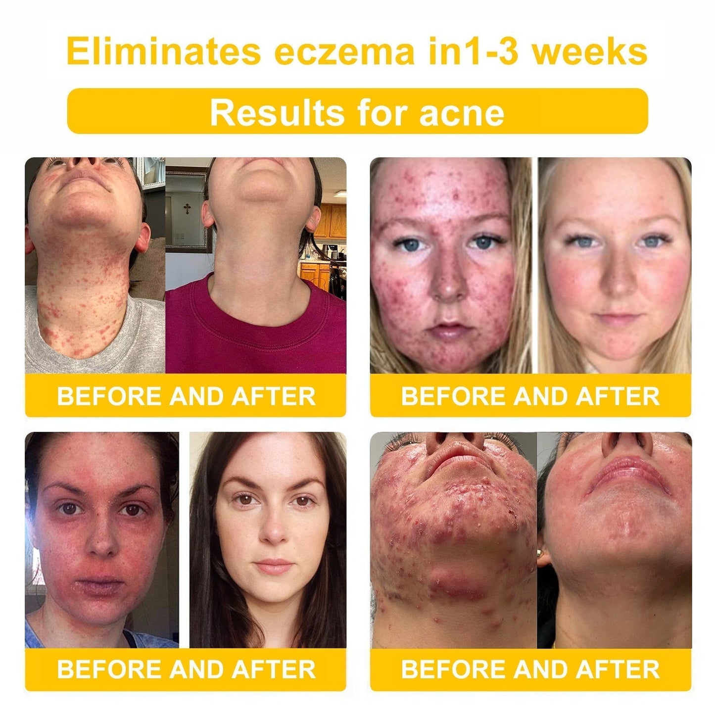 TLOPA® Bee Venom Skin Cream(👨⚕AAD Recommended),for Remove Warts, Acne and Scars ✅