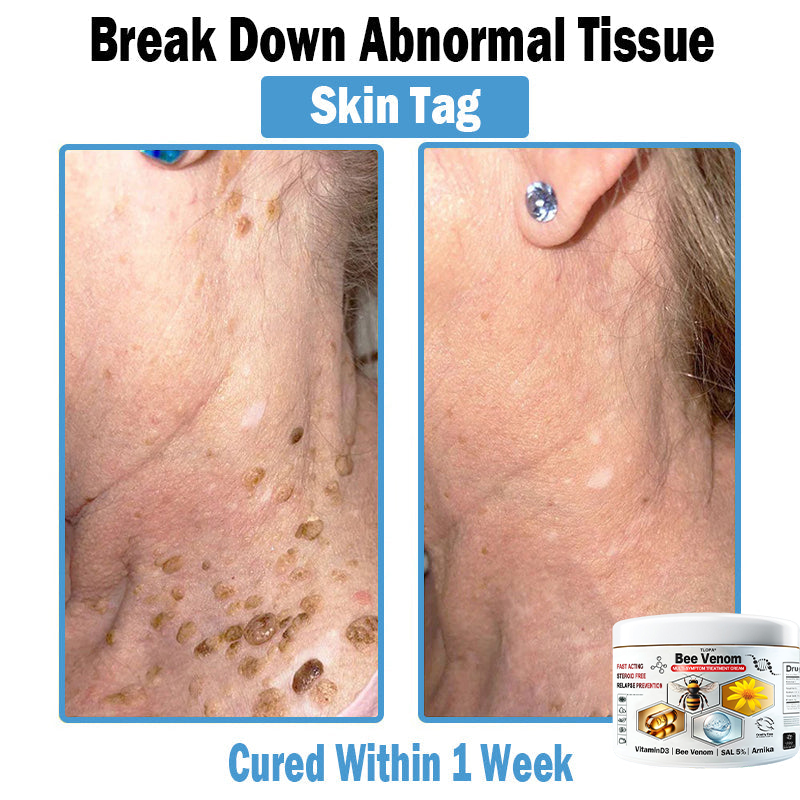 TLOPA® Bee Venom Multi-Symptom Skin Treatment Cream (👨⚕🌟Extra 30% off on sale items!