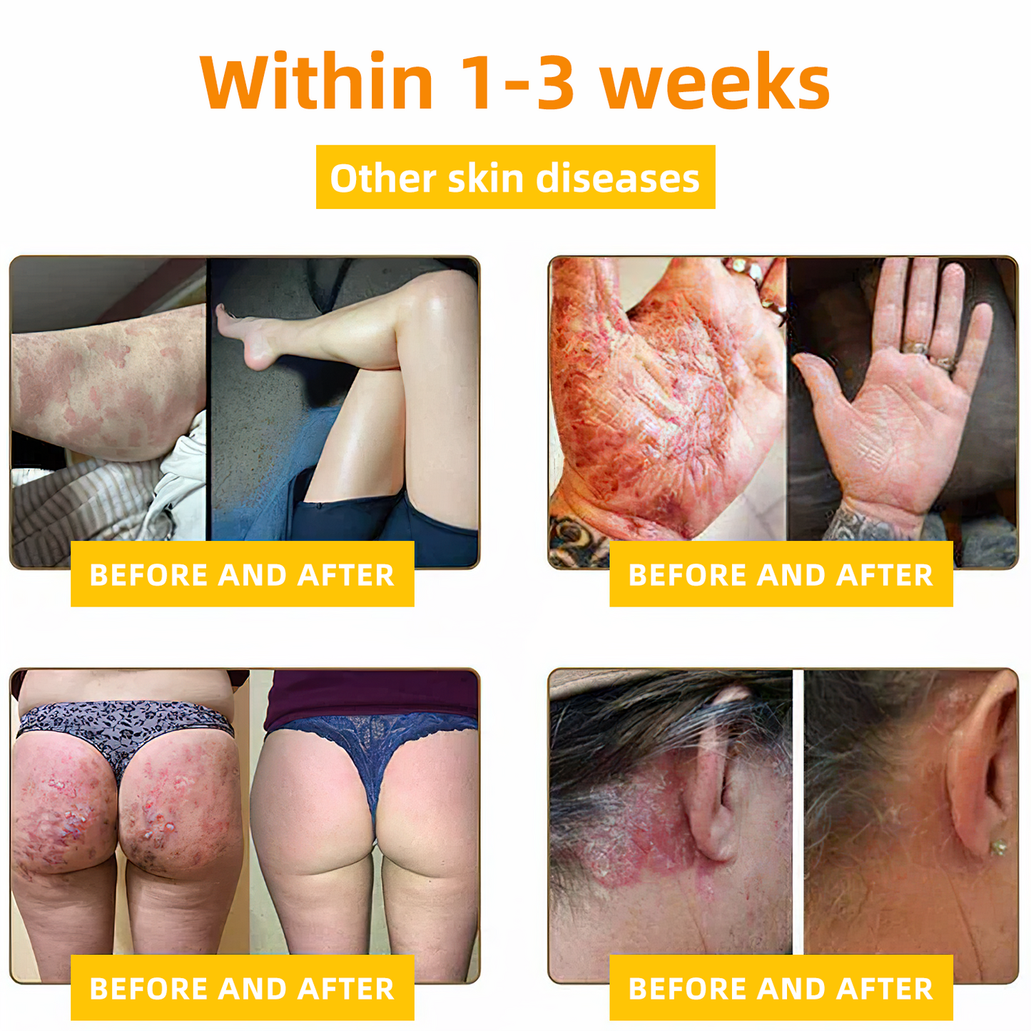 TLOPA® Bee Venom Skin Cream(👨⚕AAD Recommended),for Remove Warts, Acne and Scars ✅