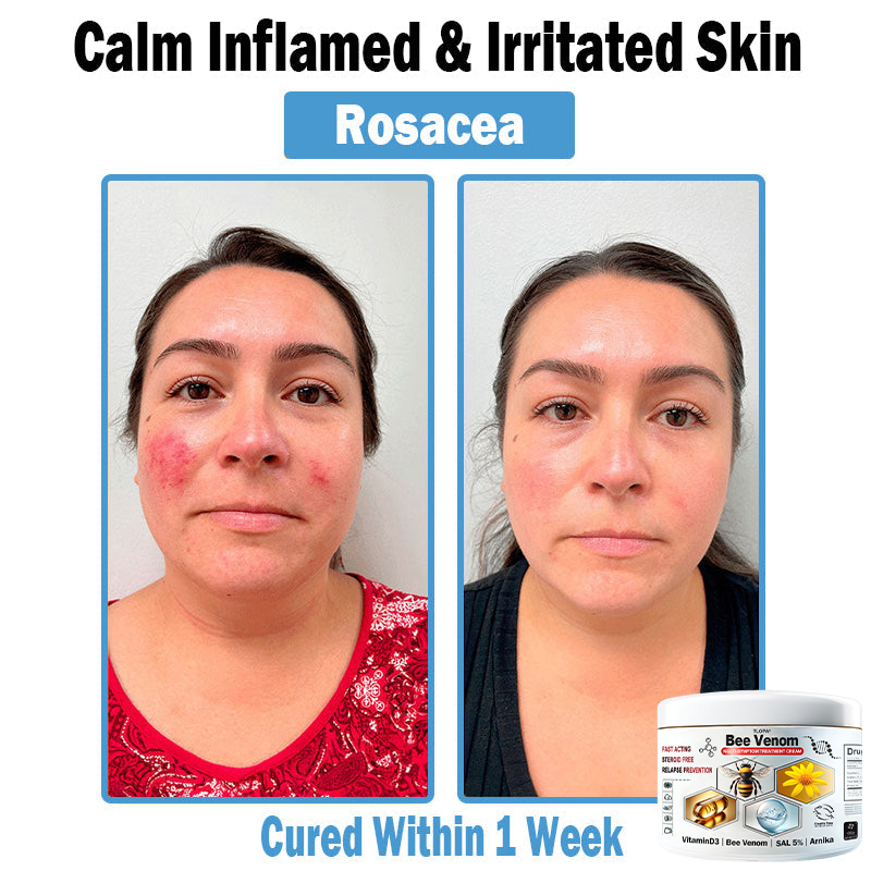 TLOPA® Bee Venom Multi-Symptom Skin Treatment Cream (👨⚕🌟Extra 30% off on sale items!