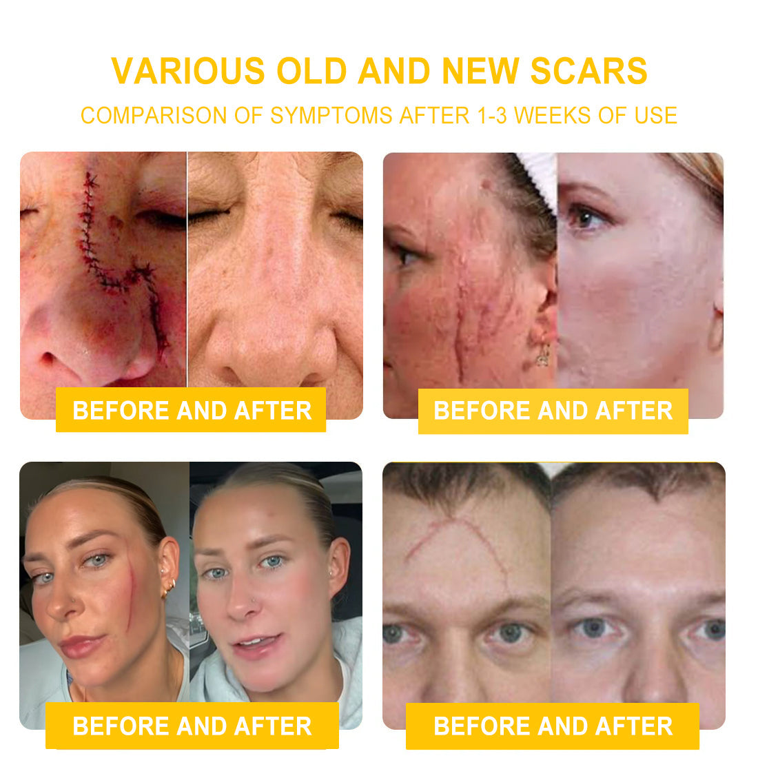 TLOPA® Bee Venom Skin Cream(👨⚕AAD Recommended),for Remove Warts, Acne and Scars ✅