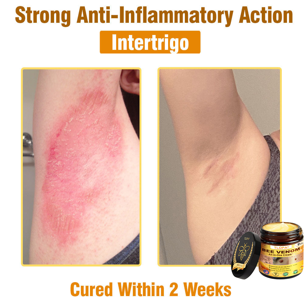 TLOPA® Bee Venom All-in-One Cream US Dermatologist Approved-