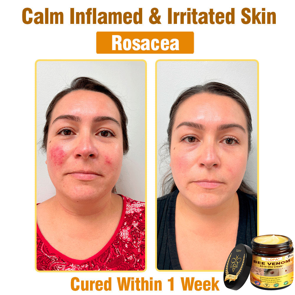 TLOPA® Bee Venom All-in-One Cream US Dermatologist Approved-