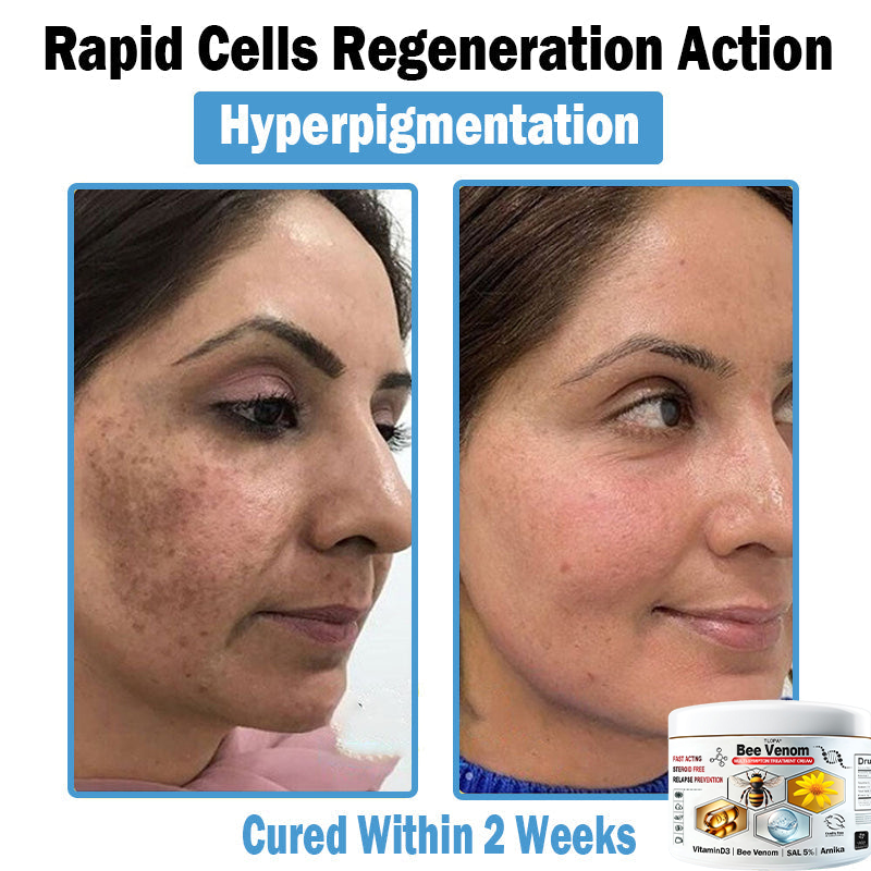 TLOPA® Bee Venom Multi-Symptom Skin Treatment Cream (👨‍⚕🌟Extra 30% off on sale items!