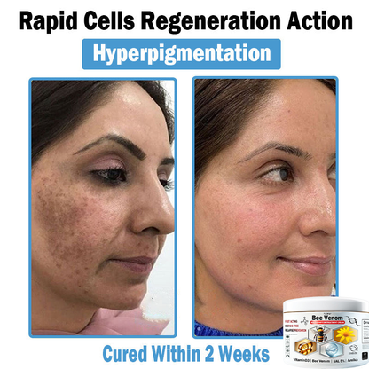 TLOPA® Bee Venom Multi-Symptom Skin Treatment Cream (👨‍⚕🌟Extra 30% off on sale items!