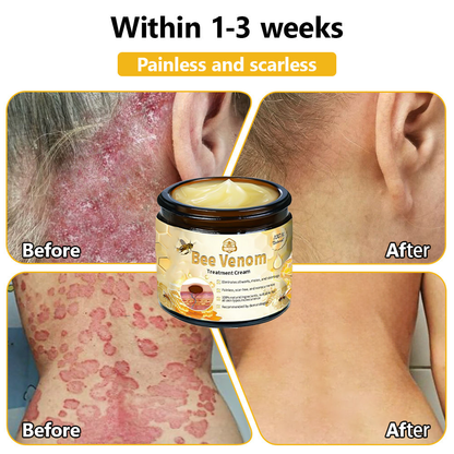 Skin tested certification | 𝙏𝙇𝙊𝙋𝘼™ Bee Venom Skin Treatment Cream (AAD Recommended) (Up to 70% off)