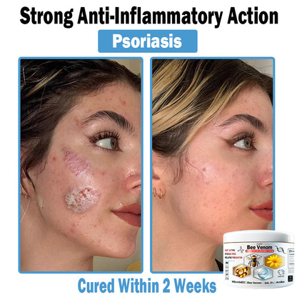TLOPA® Bee Venom Multi-Symptom Skin Treatment Cream (👨‍⚕🌟Extra 30% off on sale items!