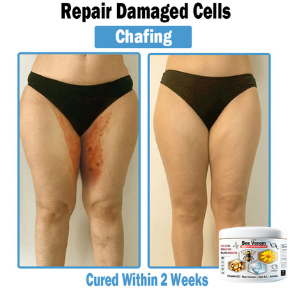 TLOPA® Bee Venom Multi-Symptom Skin Treatment Cream (👨‍⚕🌟Extra 30% off on sale items!