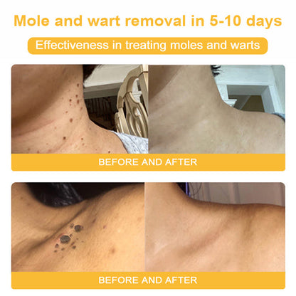 TLOPA® Bee Venom Skin Cream（👨‍⚕AAD Recommended),for Remove Warts, Acne and Scars ✅