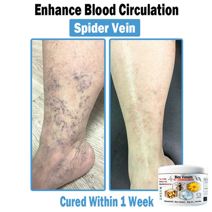 TLOPA® Bee Venom Multi-Symptom Skin Treatment Cream (👨‍⚕🌟Extra 30% off on sale items!