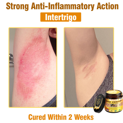 TLOPA® Bee Venom All-in-One Cream US Dermatologist Approved-