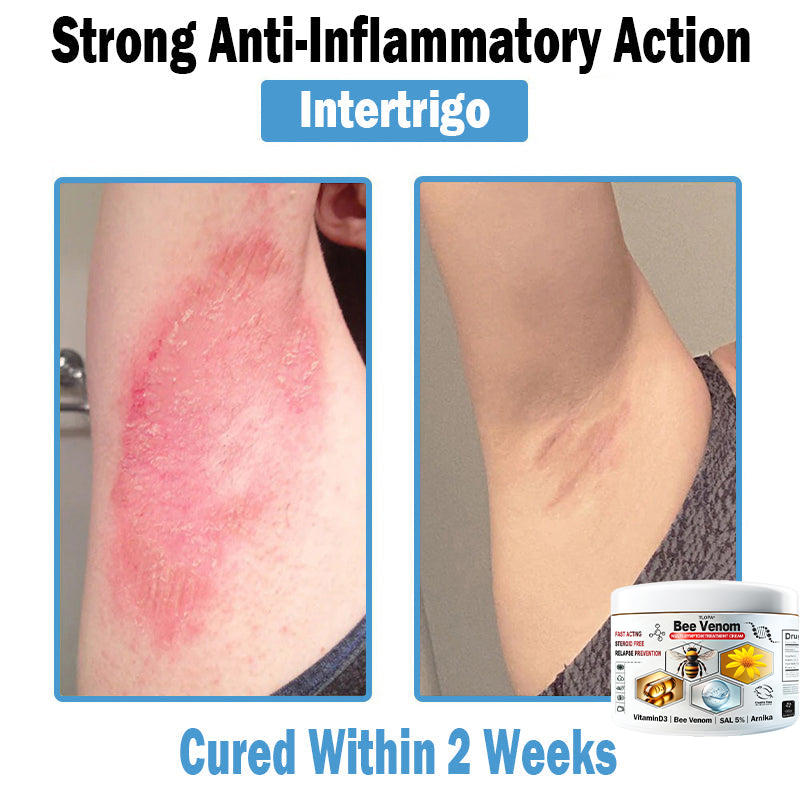 TLOPA® Bee Venom Multi-Symptom Skin Treatment Cream (👨‍⚕🌟Extra 30% off on sale items!